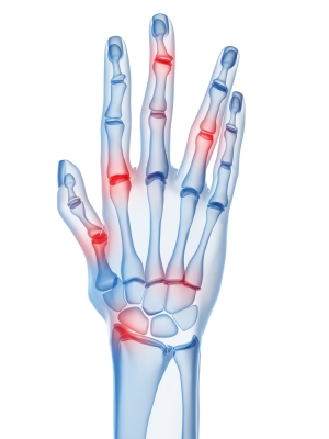 Arthritis is a chronic medical condition which may be alleviated by the use of a lift chair.
